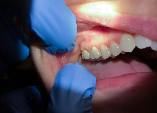 Best Emergency Treatment for Dental Infections or Abscesses in Weslaco, TX